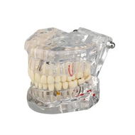 Detailed information about the product Transparent Disease Teeth Model with Dental Implant Bridge,Dental Model for Patient and Dental Student Education